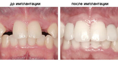 Имплантация зубов под ключ в Уфе: цена, отзывы и запись